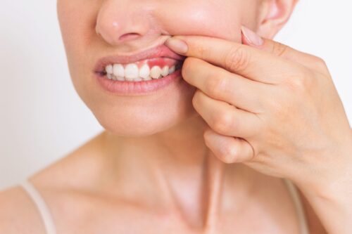 closeup of a woman pulling up her lip exposing red, swollen gums, possible early signs of gum disease