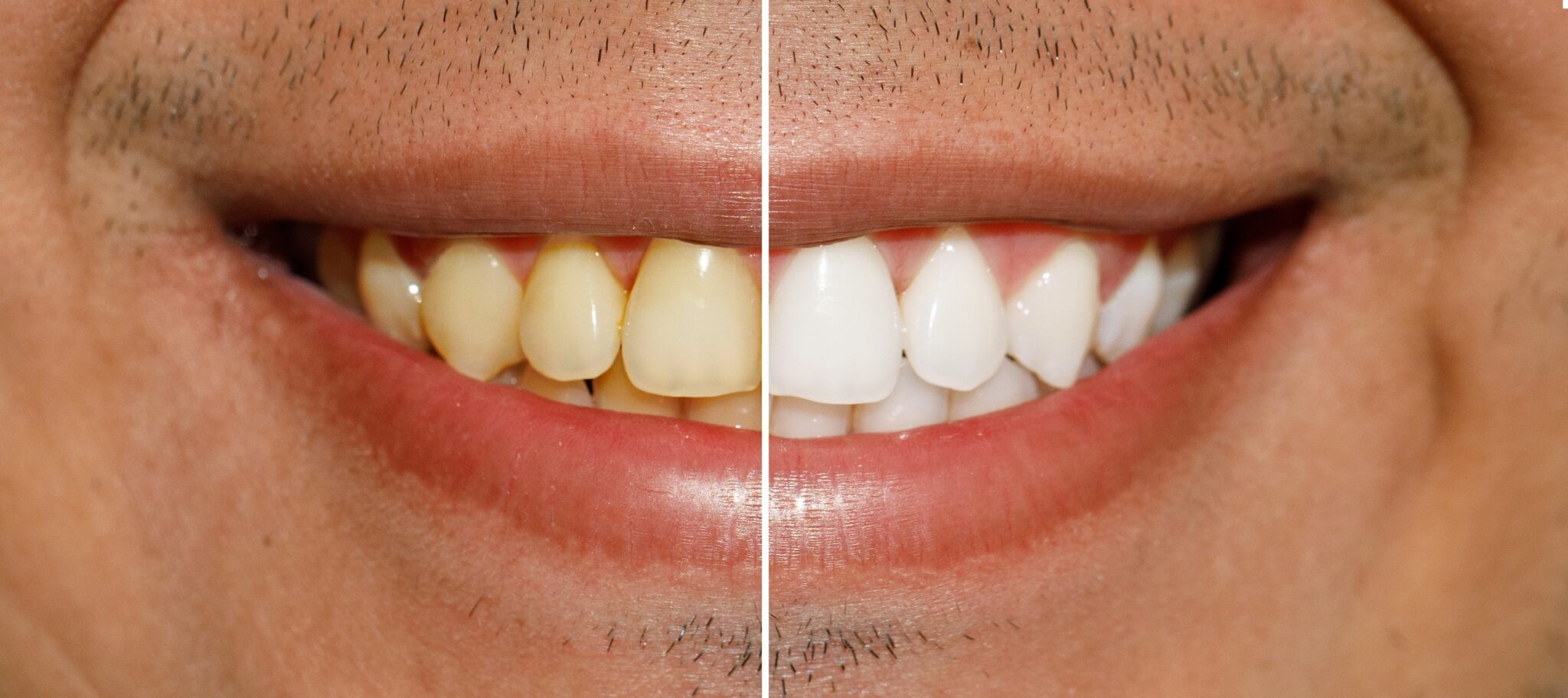 before and after teeth whitening from Oak Hills Dentistry