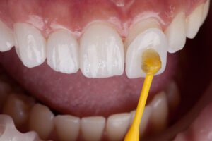 close up application of porcelain dental veneers