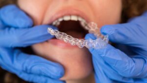 dentist fitting a patients clear aligners in Spring, TX