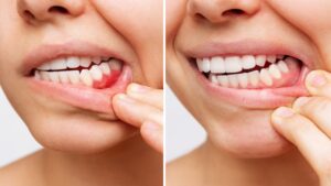 side by side of gum disease progression