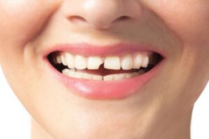 Woman smiles with broken tooth. Need a Dentist. Close up photo white background